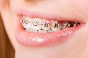 Orthodontic | EK Dental Surgery - Dentist Glen Waverley