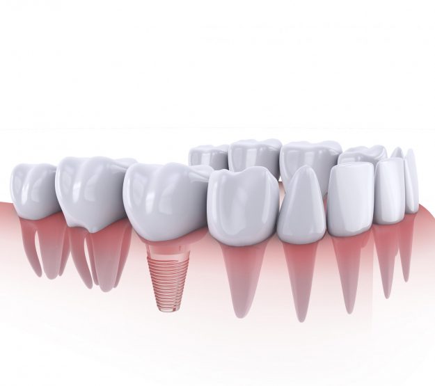 Glen Waverley Dentist Trivia Top 5 Myths about Dental Implants