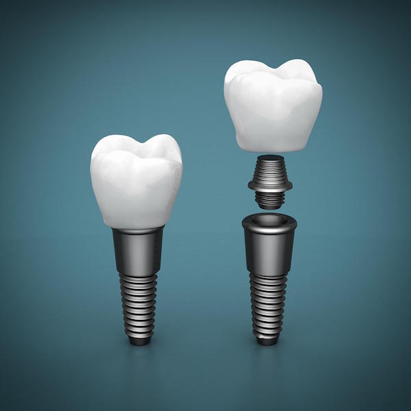 Ease, Comfort, Appearance The Dental Implant Advantage