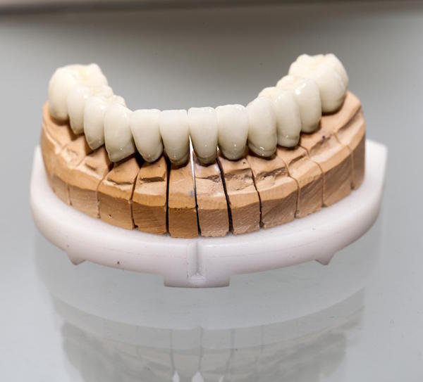 What is the Lifespan of a Dental Crown?