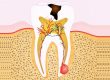 The Ultimate Guide to Root Canal In Glen Waverly
