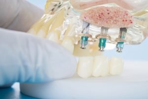 Dental Implants in Glen Waverley Should You Shop Around