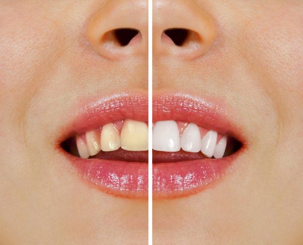 Glen Waverley Dentist Tips Over-the-Counter Teeth Whitening vs Professional At-Home Whitening