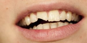 causes-of-broken-tooth-glen-waverley